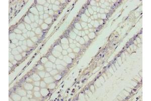 Immunohistochemistry of paraffin-embedded human colon cancer using ABIN7166002 at dilution of 1:100 (RD3 抗体  (AA 1-195))