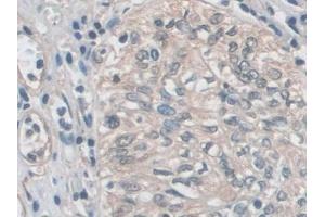 Detection of EZR in Human Prostate cancer Tissue using Polyclonal Antibody to Ezrin (EZR) (Ezrin 抗体  (AA 1-295))
