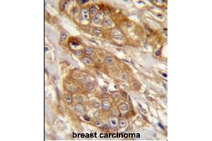 GRINA Antibody (Center) (ABIN657481 and ABIN2846508) immunohistochemistry analysis in formalin fixed and paraffin embedded human breast carcinoma followed by peroxidase conjugation of the secondary antibody and DAB staining. (GRINA 抗体  (AA 131-158))