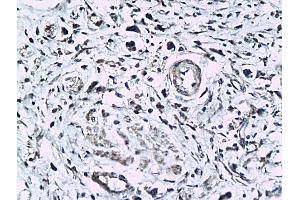 Formalin-fixed and paraffin embedded human colorectal cancer labeled with Anti-phospho-KLF5(Ser275) Polyclonal Antibody, Unconjugated (ABIN676778) followed by conjugation to the secondary antibody and DAB staining (KLF5 抗体  (pSer275))