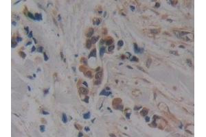 Detection of MAPT in Human Breast cancer Tissue using Polyclonal Antibody to Tau Protein (MAPT) (tau 抗体  (AA 130-386))