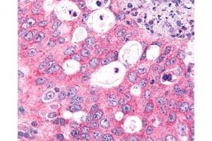 Anti-FZD6 / Frizzled 6 antibody IHC of human Lung, Non-Small Cell Carcinoma. (FZD6 抗体  (N-Term))