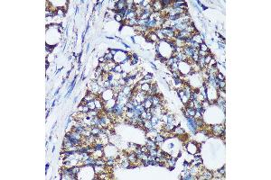 Immunohistochemistry of paraffin-embedded Human colon carcinoma using CDKL3 Rabbit pAb (ABIN7266612) at dilution of 1:100 (40x lens). (CDKL3 抗体  (AA 1-120))