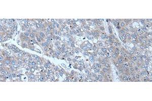 Immunohistochemistry of paraffin-embedded Human liver cancer tissue using SLC24A5 Polyclonal Antibody at dilution of 1:50(x200) (SLC24A5 抗体)