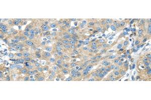 Immunohistochemistry of paraffin-embedded Human breast cancer using TXNDC5 Polyclonal Antibody at dilution of 1/40 (TXNDC5 抗体)