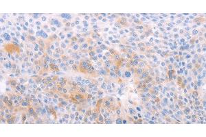 Immunohistochemistry of paraffin-embedded Human liver cancer using EDG6 Polyclonal Antibody at dilution of 1:40 (S1PR4 抗体)