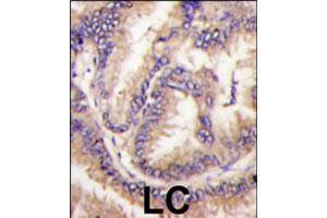 Formalin-fixed and paraffin-embedded human lung carcinoma tissue reacted with CDKL5 polyclonal antibody  , which was peroxidase-conjugated to the secondary antibody, followed by DAB staining. (CDKL5 抗体  (C-Term))