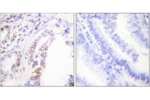 Immunohistochemistry analysis of paraffin-embedded human lung carcinoma tissue, using AML1 (Ab-303) Antibody.