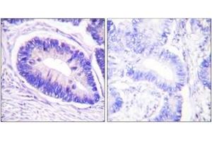 Immunohistochemistry analysis of paraffin-embedded human colon carcinoma, using MYPT1 (Phospho-Thr853) Antibody. (PPP1R12A 抗体  (pThr853))