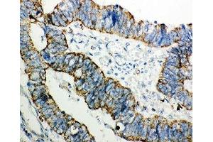 IHC-P: PRDX3 antibody testing of human intestinal cancer tissue (Peroxiredoxin 3 抗体  (AA 110-256))