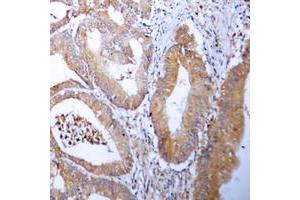 Immunohistochemical analysis of ACC alpha staining in human colon cancer formalin fixed paraffin embedded tissue section. (Acetyl-CoA Carboxylase alpha 抗体  (N-Term))