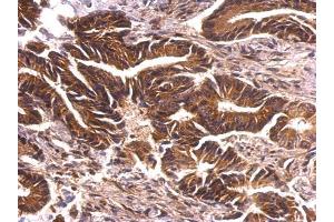 IHC-P Image PRK2 antibody [N1N3] detects PRK2 protein at cytosol on human colon carcinoma by immunohistochemical analysis. (PKN2 抗体)