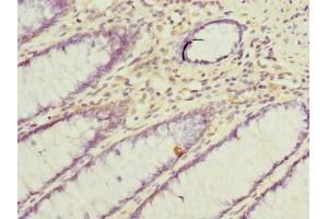 Immunohistochemistry of paraffin-embedded human colon cancer using ABIN7171111 at dilution of 1:100 (VAT1L 抗体  (AA 1-419))