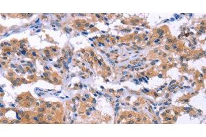 Immunohistochemistry of paraffin-embedded Human thyroid cancer using ESPL1 Polyclonal Antibody at dilution of 1:40 (Separase 抗体)