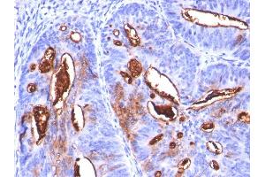 Formalin-fixed, paraffin-embedded human Colon Carcinoma stained with CA19-9 Monoclonal Antibody (SPM588). (CA 19-9 抗体)