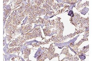 ABIN6268851 at 1/100 staining Human breast cancer tissue by IHC-P.
