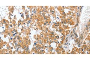 Immunohistochemistry of paraffin-embedded Human thyroid cancer tissue using CHMP4B Polyclonal Antibody at dilution 1:40 (CHMP4B 抗体)