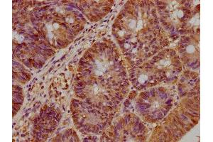 IHC image of ABIN7145754 diluted at 1:300 and staining in paraffin-embedded human colon cancer performed on a Leica BondTM system. (BAAT1 抗体  (AA 603-821))