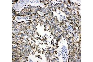 Anti-Grp75 antibody, IHC(P) IHC(P): Human Lung Cancer Tissue (HSPA9 抗体  (C-Term))