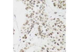 Immunohistochemistry of paraffin-embedded human esophageal cancer using EDF1 antibody.