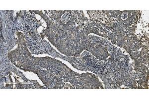 IHC analysis of MAP3K8 using anti-MAP3K8 antibody (ABIN4886663). (MAP3K8 抗体  (AA 9-193))