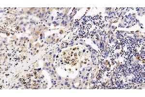 Detection of CXCR4 in Human Lung cancer Tissue using Polyclonal Antibody to Chemokine C-X-C-Motif Receptor 4 (CXCR4) (CXCR4 抗体  (AA 262-352))