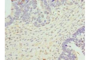 Immunohistochemistry of paraffin-embedded human ovarian cancer using ABIN7149288 at dilution of 1:100 (Cytohesin 2 抗体  (AA 150-350))