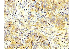 IHC image of ABIN7166908 diluted at 1:400 and staining in paraffin-embedded human pancreatic cancer performed on a Leica BondTM system. (PKM 抗体  (AA 185-461))