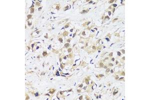 Immunohistochemistry of paraffin-embedded human breast cancer using  antibody (ABIN7265374) at dilution of 1:100 (40x lens). (ASCL4 抗体  (AA 1-172))