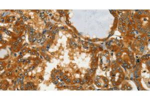 Immunohistochemistry of paraffin-embedded Human thyroid cancer using GOT1 Polyclonal Antibody at dilution of 1:50 (GOT1 抗体)