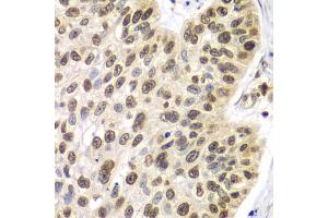 Immunohistochemistry of paraffin-embedded human lung cancer using SEPT7 antibody. (Septin 7 抗体)