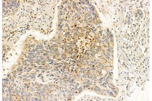 ABIN6261583 and ABIN6272916 at 1/100 staining Human lung cancer by IHC-P. (ERAL1 抗体  (Internal Region))