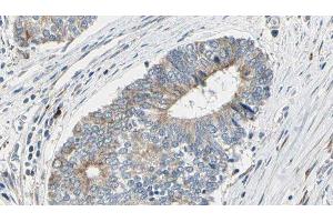 ABIN6277182 at 1/100 staining Human prostate tissue by IHC-P. (Dynamitin 抗体  (C-Term))