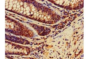IHC image of ABIN7150205 diluted at 1:400 and staining in paraffin-embedded human colon cancer performed on a Leica BondTM system. (MSH2 抗体  (AA 2-254))