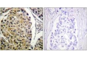 Immunohistochemistry analysis of paraffin-embedded human breast carcinoma, using PKC delta (Phospho-Tyr313) Antibody. (PKC delta 抗体  (pTyr313))