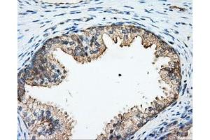 Immunohistochemical staining of paraffin-embedded Adenocarcinoma of colon tissue using anti-ARHGDIA mouse monoclonal antibody. (ARHGDIA 抗体)