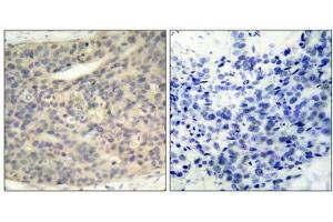 Immunohistochemical analysis of paraffin- embedded human breast carcinoma tissue, using LIMK1 (phospho- Thr508) antibody (E011126). (LIM Domain Kinase 1 抗体  (pThr508))