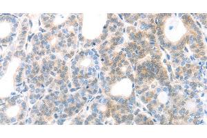 Immunohistochemistry of paraffin-embedded Human thyroid cancer using MAGED1 Polyclonal Antibody at dilution of 1:30 (MAGED1 抗体)