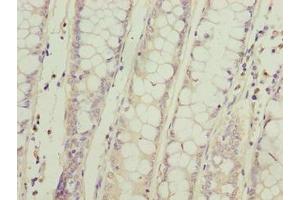 Immunohistochemistry of paraffin-embedded human colon cancer using ABIN7169615 at dilution of 1:100 (SPCS2 抗体  (AA 7-86))