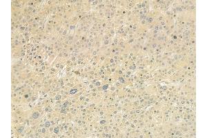 ABIN6261001 and ABIN6279253 at 1/100 staining human hepatocellular carcinoma by IHC-P. (CPD 抗体  (N-Term))