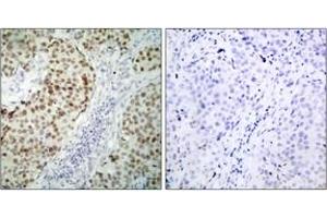 Immunohistochemistry analysis of paraffin-embedded human breast carcinoma tissue, using p53 (Ab-6) Antibody. (p53 抗体  (AA 1-50))