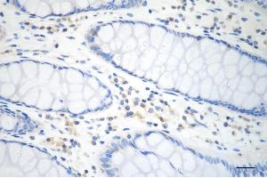 Immunohistochemistry was performed on paraffin-embedded human sigmoid colon carcinoma using COPS8 antibody (ABIN7798152), 1:200). (Recombinant COPS8 抗体)