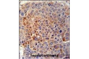 GPLD1 Antibody (C-term) (ABIN389063 and ABIN2839268) immunohistochemistry analysis in formalin fixed and paraffin embedded human hepatocarcinoma tissue followed by peroxidase conjugation of the secondary antibody and DAB staining. (GPLD1 抗体  (C-Term))