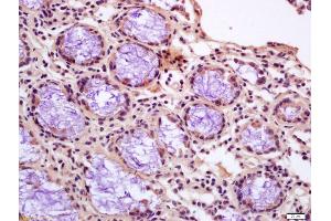 Formalin-fixed and paraffin embedded human gastric carcinoma labeled with Anti-Calponin 1/COLP Polyclonal Antibody, Unconjugated (ABIN724820) at 1:200 followed by conjugation to the secondary antibody and DAB staining (CNN1 抗体  (AA 201-297))