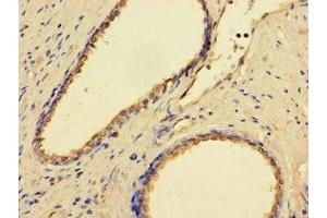 Immunohistochemistry of paraffin-embedded human prostate cancer using ABIN7158978 at dilution of 1:100 (GMPPB 抗体  (AA 61-360))