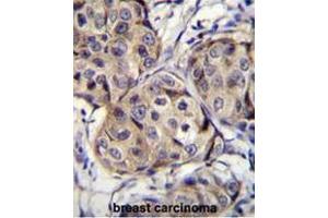 CBLN2 Antibody (C-term) immunohistochemistry analysis in formalin fixed and paraffin embedded human breast carcinoma followed by peroxidase conjugation of the secondary antibody and DAB staining. (CBLN2 抗体  (C-Term))