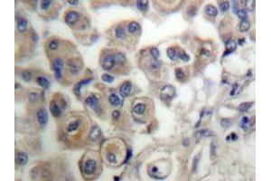 Immunohistochemistry analyzes of PLC β3 antibody in paraffin-embedded human breast carcinoma tissue. (PLCB3 抗体)
