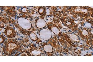 Immunohistochemistry of paraffin-embedded Human thyroid cancer tissue using FABP3 Polyclonal Antibody at dilution 1:40 (FABP3 抗体)