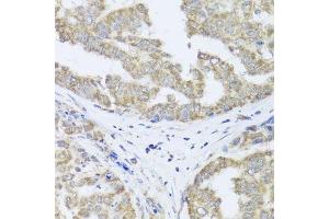 Immunohistochemistry of paraffin-embedded human liver cancer using TIMM10B antibody. (TIMM10B 抗体  (AA 1-103))