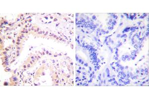 Peptide - +Immunohistochemical analysis of paraffin-embedded human lung carcinoma tissue using Cullin 2 antibody (#C0163).